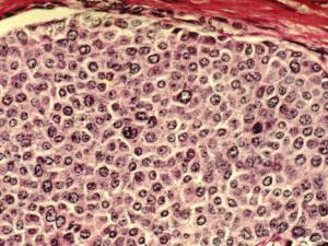 La inmunoterapia consigue por primera vez curar un cáncer de mama. / Dr. Cecil Fox (WIKIMEDIA)