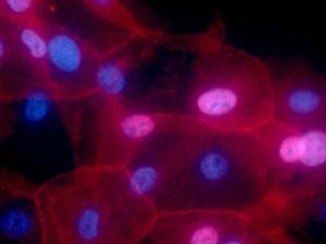 Células cáncer de mama. / Ewa Krawczyk, National Cancer Institute \ Georgetown Lombardi Comprehensive Cancer Center, National Institutes of Health (FLICKR)